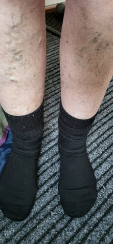 Kundens svarta Diasocks Komfortstrumpor som har sjunkit ner något runt anklarna.