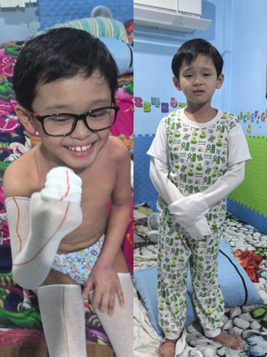 Customer photo review of Eczema Scratch Mitten