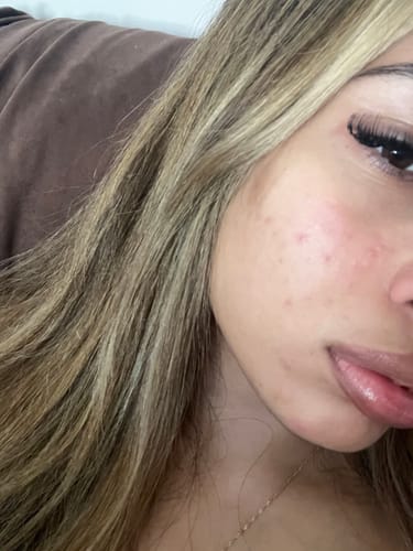 Close-up of a reviewer's cheek showing reduced redness and fewer bumps after using the Starter Acne Program™.