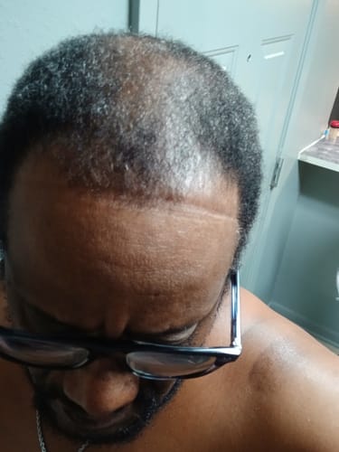 Reviewer's scalp showing new, short hair growth in thinning areas after using Rennora Hair Growth Serum.