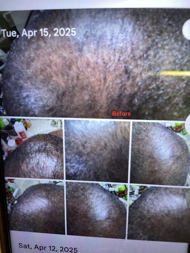 Customer's collage of 'before' photos showing a scalp with thin, dark hair prior to using Rennora Hair Growth Serum.