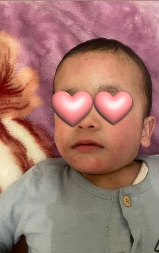 Customer's photo of a baby with red, irritated skin on their face, the condition treated with Calm Balm.
