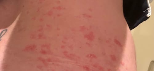 Close-up of customer's irritated skin showing widespread red patches before using Multi Strain Biotic.