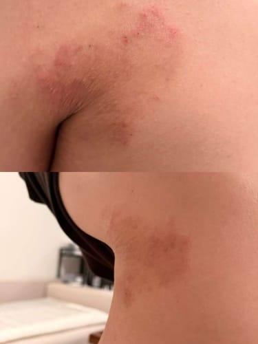 Customer photo review of Eczema Scratch Mitten