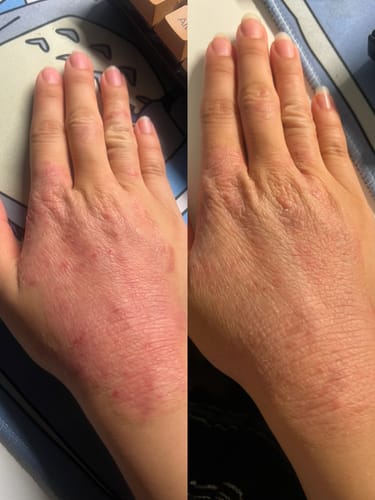 Customer photo review of Eczema Scratch Mitten