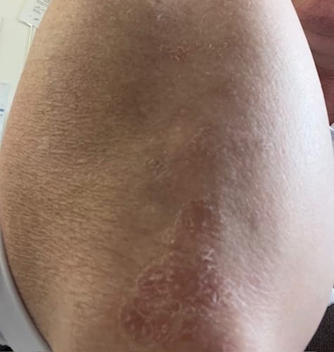 Close-up of a reviewer's arm showing improved, clearer skin after taking Multi Strain Biotic.