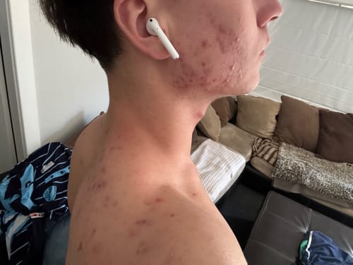 Customer's side profile showing active acne on their face, neck, and shoulder area before use.