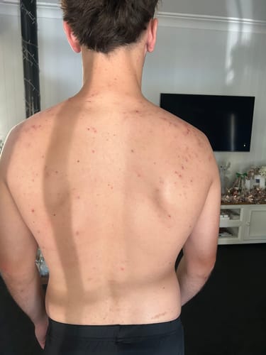 Customer's back showing moderate acne and redness before using the Intermediate Acne Program™.