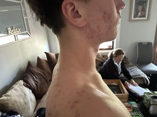 Reviewer's side profile showing acne on the face, neck, and shoulder before using Pimple Pals.