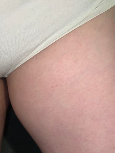 Close-up of a customer's bikini line, showing clear, smooth skin after using the Superfood Intimate Care Kit.