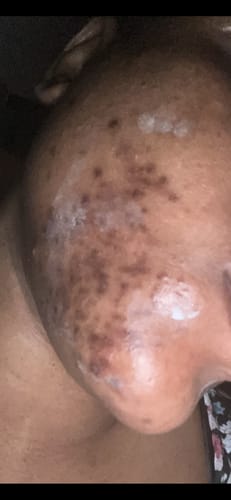 Customer photo review of Acne Treatment Set