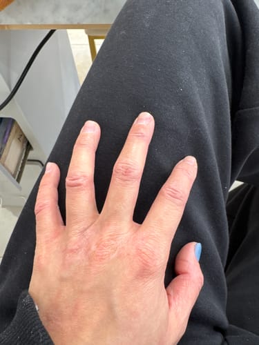 Reviewer's hand showing the improved condition of their eczema after taking the Multi Strain Biotic.