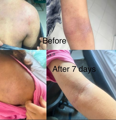 Customer photo review of Eczema Scratch Mitten