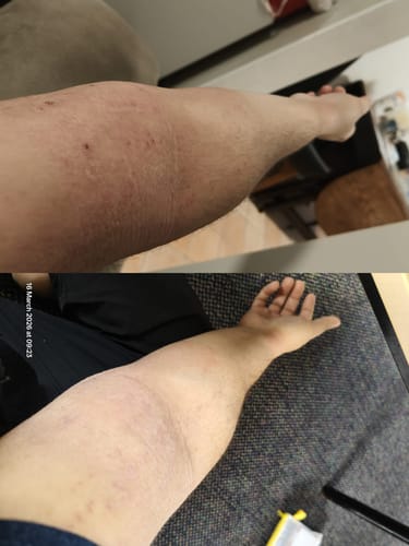 Customer photo review of Eczema Scratch Mitten