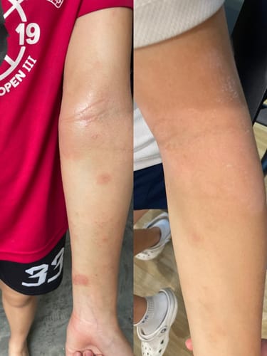 Customer photo review of Eczema Scratch Mitten