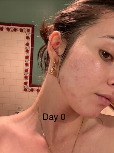 Customer's before photo on Day 0 showing breakouts on their cheek before using Skin & Gut Maintain™.