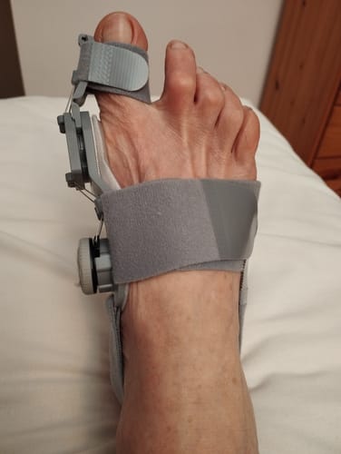 Vásárló lábán a felhelyezett szürke Ortolin éjszakai bütyökvédő és lábujjkorrigáló sín.