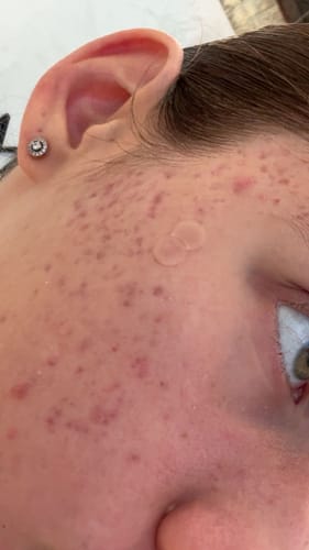 Close-up of a reviewer's skin showing two seamless Pimple Pals patches covering blemishes.