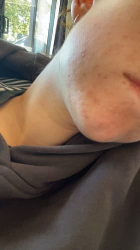 Customer's close-up of their jawline and chin, showing calmer skin after using the Intermediate Acne Program™.