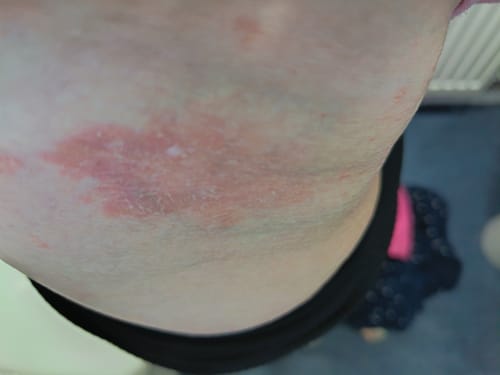 Customer shows a large red psoriasis patch on their skin that is healing after using Calm Balm.