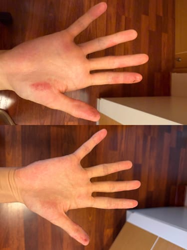 Customer photo review of Eczema Scratch Mitten