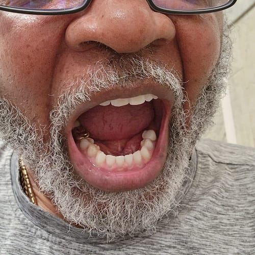 Customer photo review of Dissolving Teeth Whitening Strips