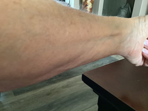 Customer's arm showing clear skin after using Arnica Montana tablets to treat bruises.
