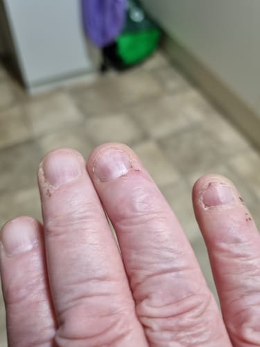 Customer photo review of Full Finger Protectors : Set of 5 β Super Stretchy Finger Protectors & Picking Support