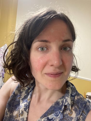 Reviewer's face showing red, uneven skin before using the Multi Strain Biotic.