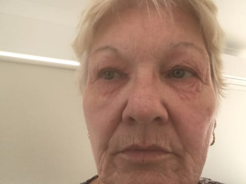 A customer's face with a dry, sore skin reaction around the eyes before using Hemp Seed Rescue Butter.