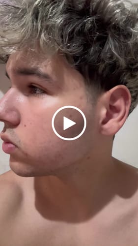 Customer video review of Advanced Acne Program™