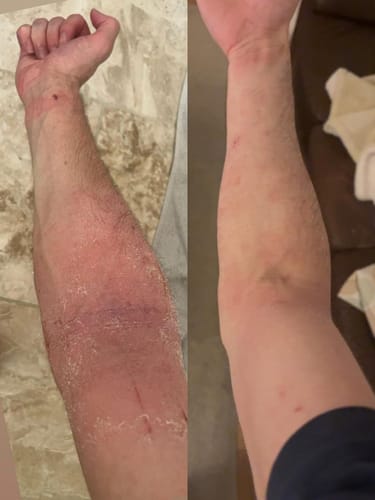 Customer photo review of Eczema Scratch Mitten