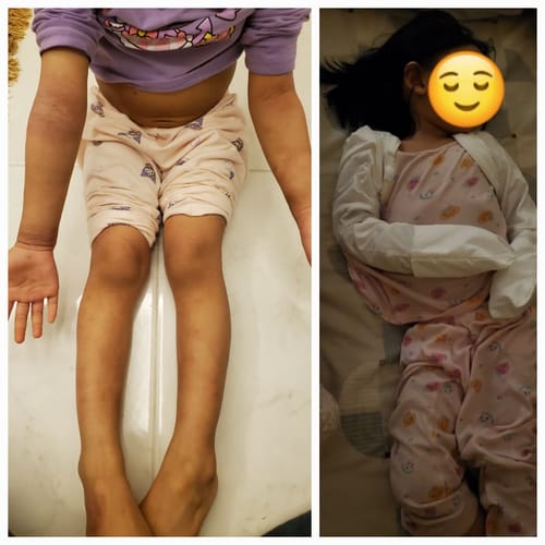 Customer photo review of Eczema Scratch Mitten