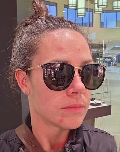 Reviewer's face showing red, irritated skin before using The Freedom Face Whip.