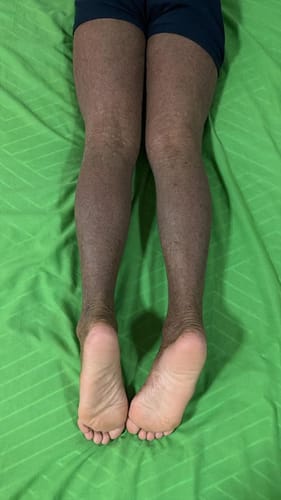 Customer photo review of Eczema Scratch Mitten