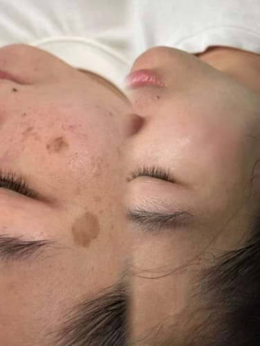 Customer photo review of Y-Axis Dark Spot Correcting Serum