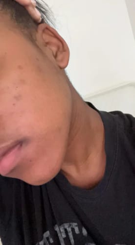 Customer photo review of Y-Axis Dark Spot Correcting Serum
