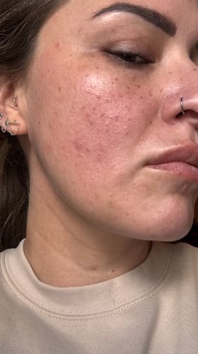 Close-up of a reviewer's cheek showing redness and texture from acne and rosacea.