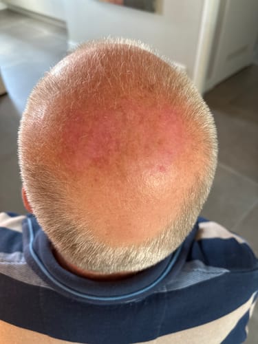 Customer photo review of Bald Head Moisturizer. 100ml.