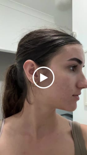 Customer video review of Advanced Acne Program™