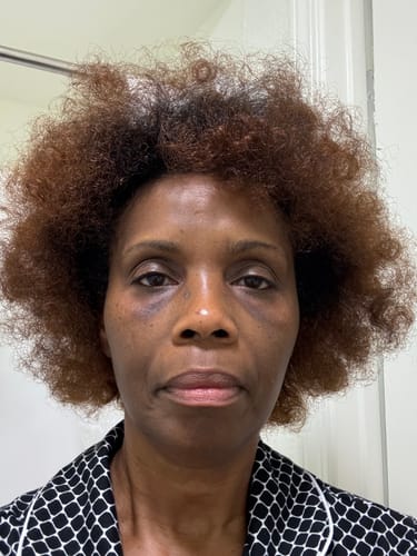 Reviewer's face before using Turmeric Fade & Glow Bar, showing dark under-eye areas.