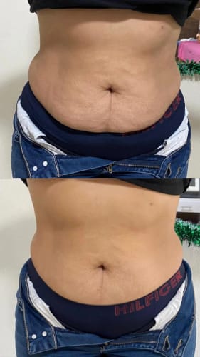 Customer photo review of GoPure By Lumi– Crema Antiestrías & Reafirmante Vientre
