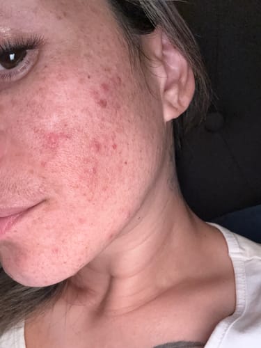 Customer's close-up showing red, blemished skin after using the daily microfoliant exfoliator.