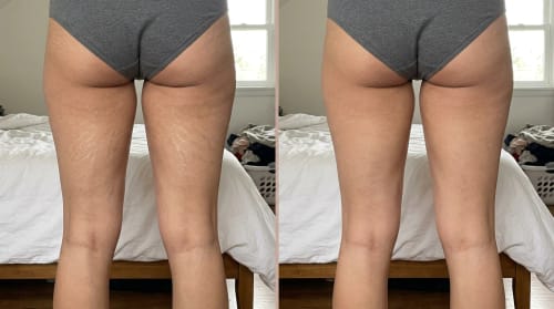 Clienta muestra el antes y después en sus piernas y glúteos. La piel se ve más lisa y con menos estrías visibles.