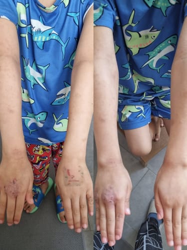 Customer photo review of Eczema Scratch Mitten