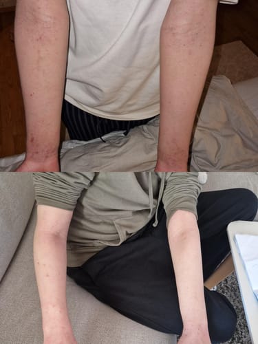 Customer photo review of Eczema Scratch Mitten