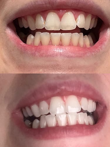 Customer photo review of V34 bieliace pásiky na zuby