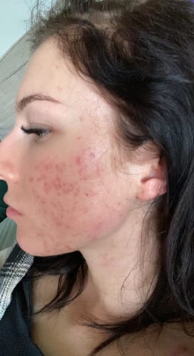 Customer's side profile showing red, inflamed skin with breakouts on their cheek before using GutGlow™ Collagen.