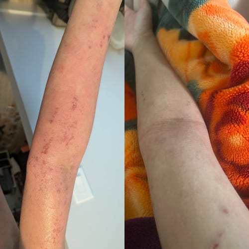 Customer photo review of Eczema Scratch Mitten
