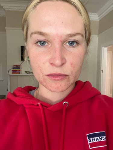 Customer's face before treatment, showing inflamed red acne around her chin and mouth.